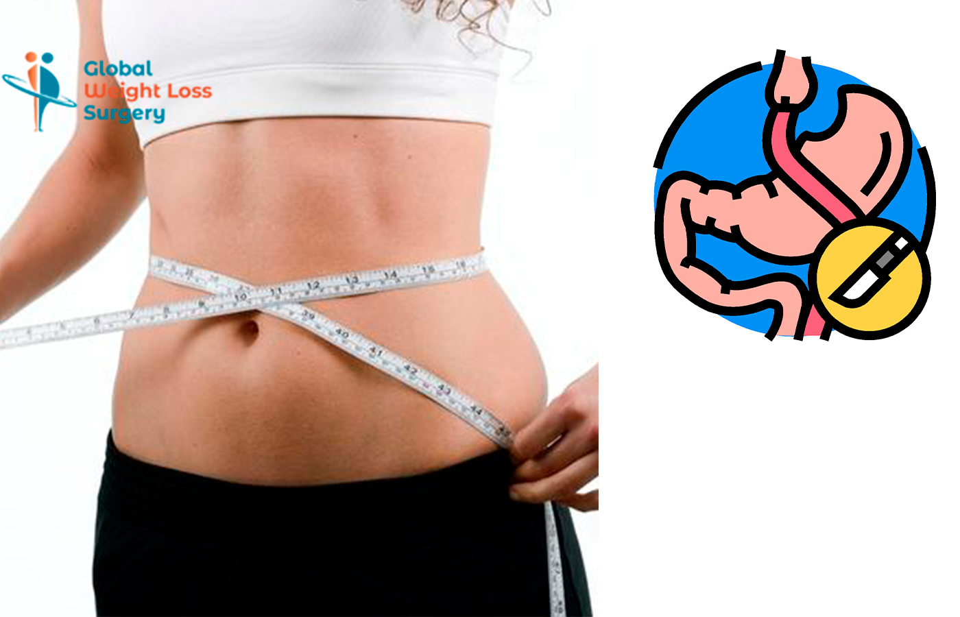 Types of Gastric Bypass Surgeries in tijuana