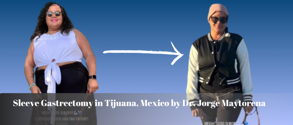 Sleeve Gastrectomy in Tijuana, Mexico by Dr. Jorge Maytorena